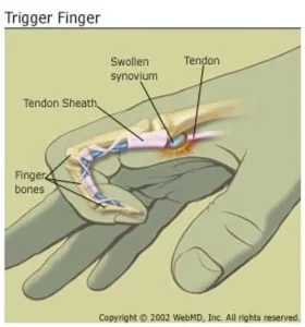 arthritis trigger finger trigger finger